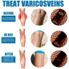 Varicose Veins Treatment Spray – Advanced Formula for Spider Veins, Leg Pain & Swelling Relief ~ 30ml